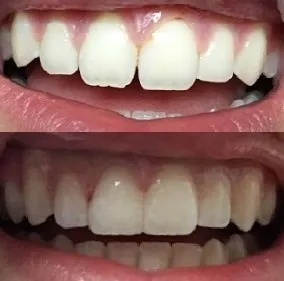 Before and After smile gallery photo