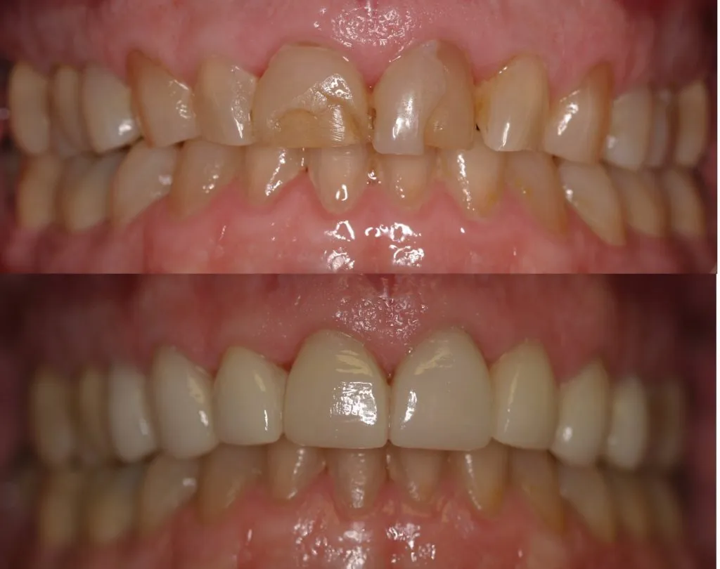 Before and After smile gallery photo