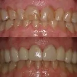 Before and After smile gallery photo