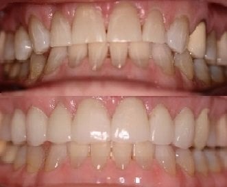 Before and After smile gallery photo