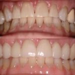 Before and After smile gallery photo