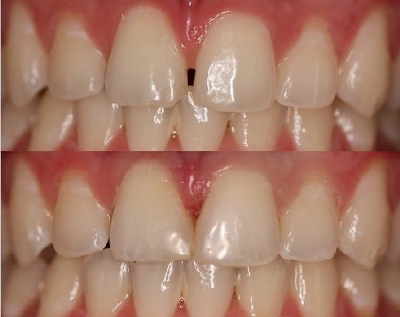 Before and After smile gallery photo