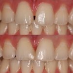 Before and After smile gallery photo