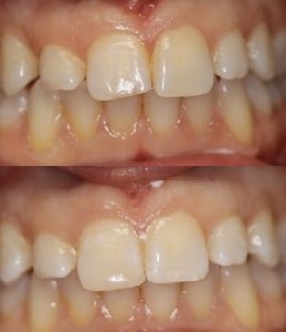 Before and After smile gallery photo