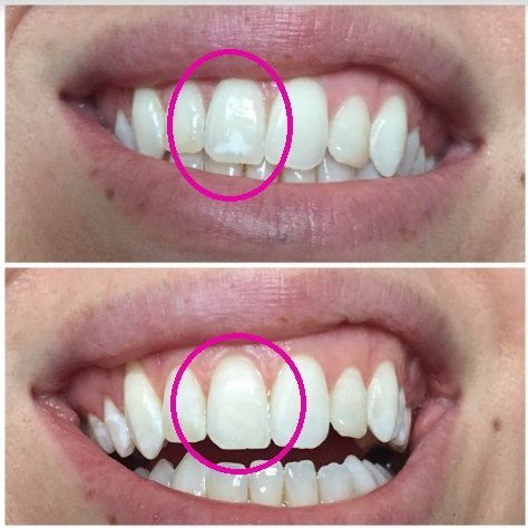Before and After smile gallery photo