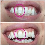 Before and After smile gallery photo