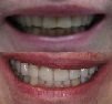Before and After smile gallery photo