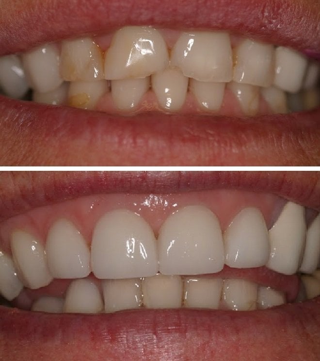 Before and After smile gallery photo
