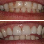 Before and After smile gallery photo