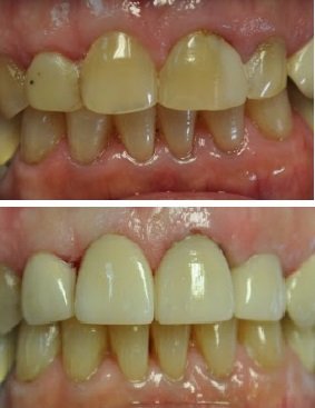 Before and After smile gallery photo