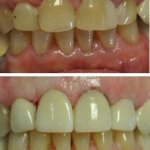 Before and After smile gallery photo