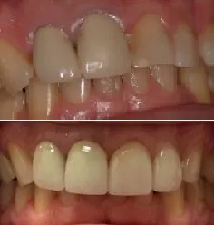 Before and After smile gallery photo