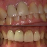 Before and After smile gallery photo