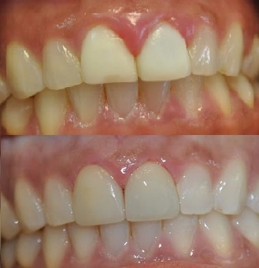 Before and After smile gallery photo
