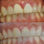 Before and After smile gallery photo