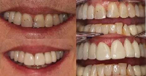 Before and After smile gallery photo