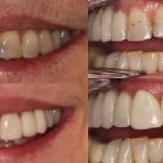 Before and After smile gallery photo