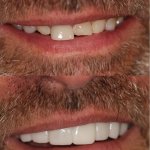 Before and After smile gallery photo