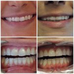 before and after dental treatment