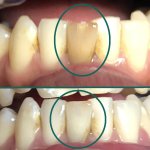 smile gallery photo identifying 1 tooth